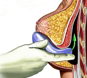 implantation to enlarge breasts
