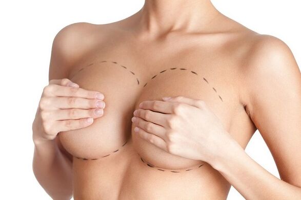 marked for breast augmentation surgery