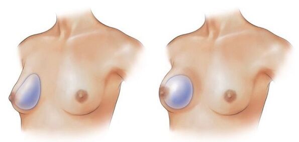 round and teardrop implants for breast augmentation