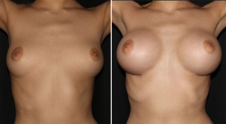 Before and after breast augmentation surgery. 