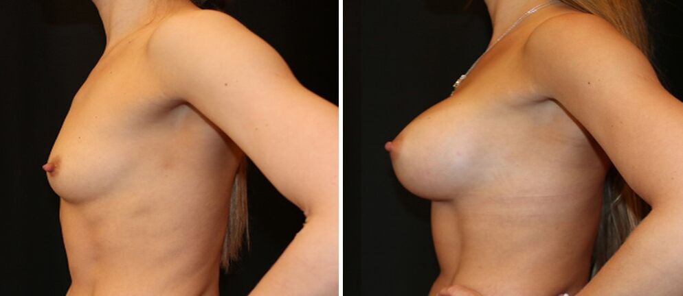 Breasts before and after augmentation. 